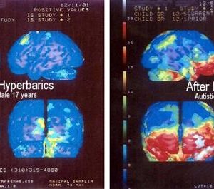 1530924672011 hyperbaric st 901