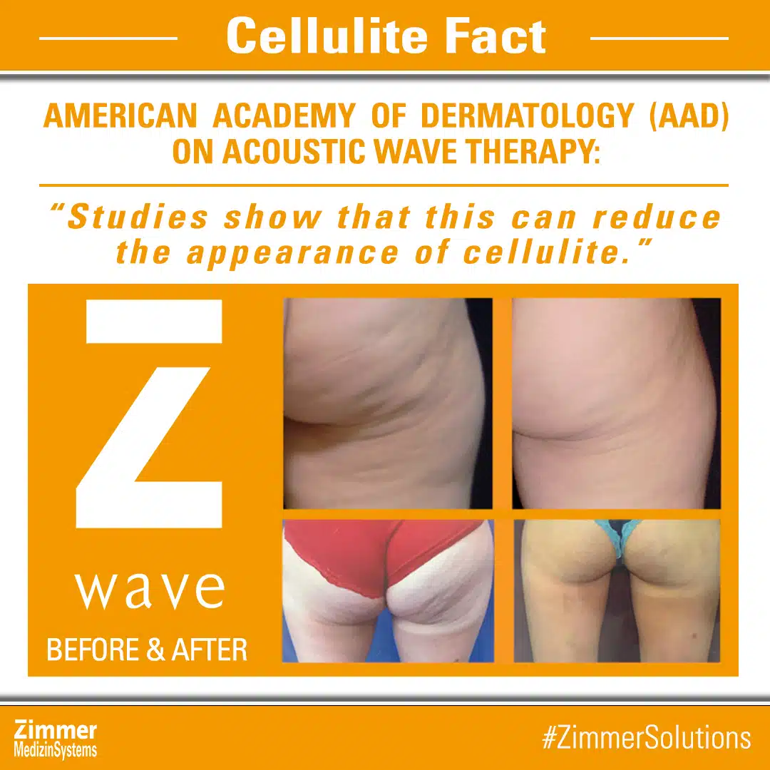 Zimmer Z Wave Q Acoustic Wave Therapy for Cellulite Skin