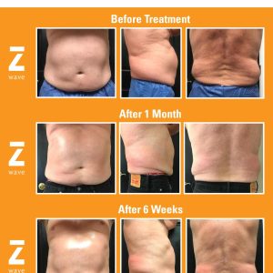 Dr. Rakesh Nanda Z Wave Before After Collage 5 2019 scaled