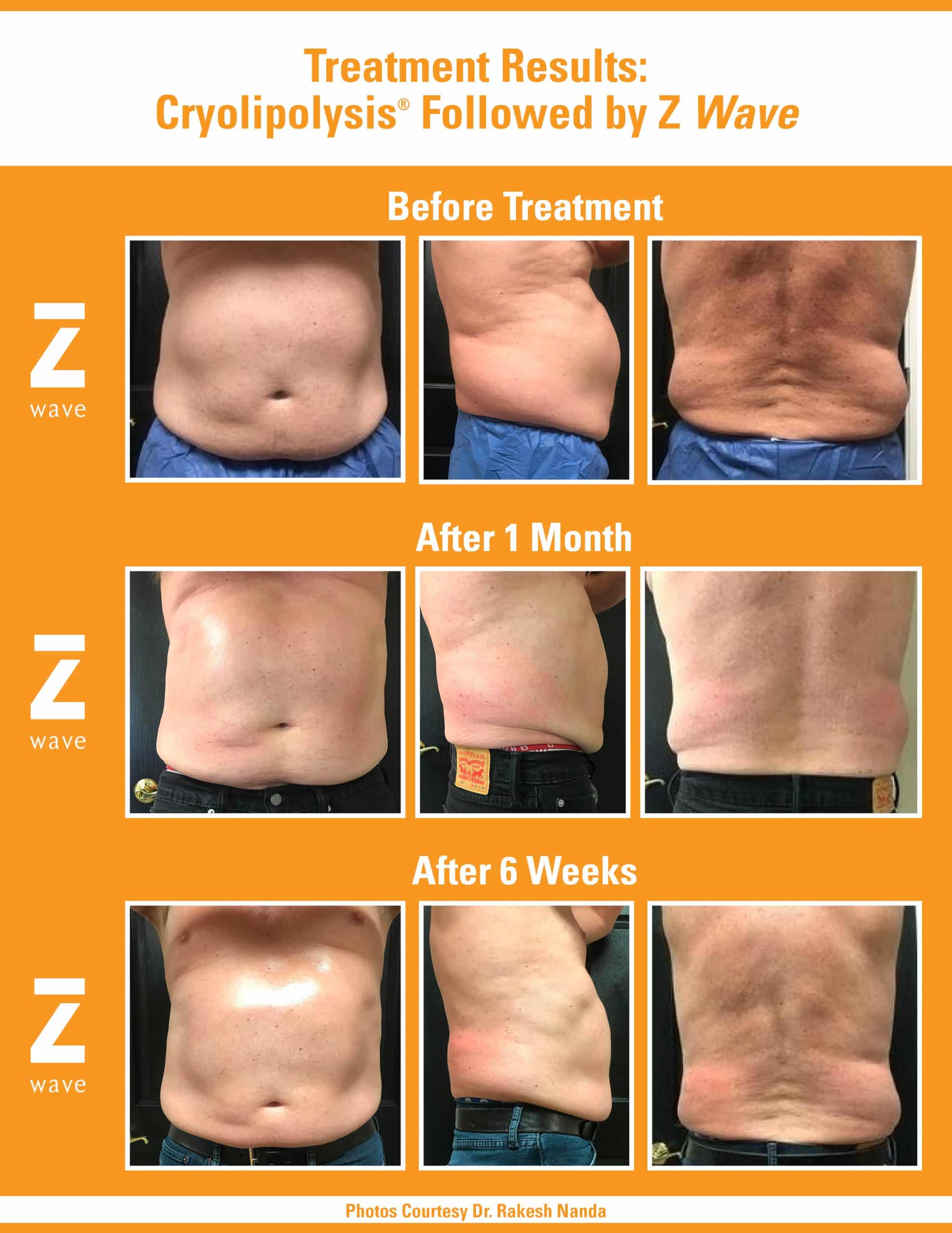 アムウェイヘッドスパ Zimmer Z Wave Q | Acoustic Wave Therapy for Cellulite & Skin